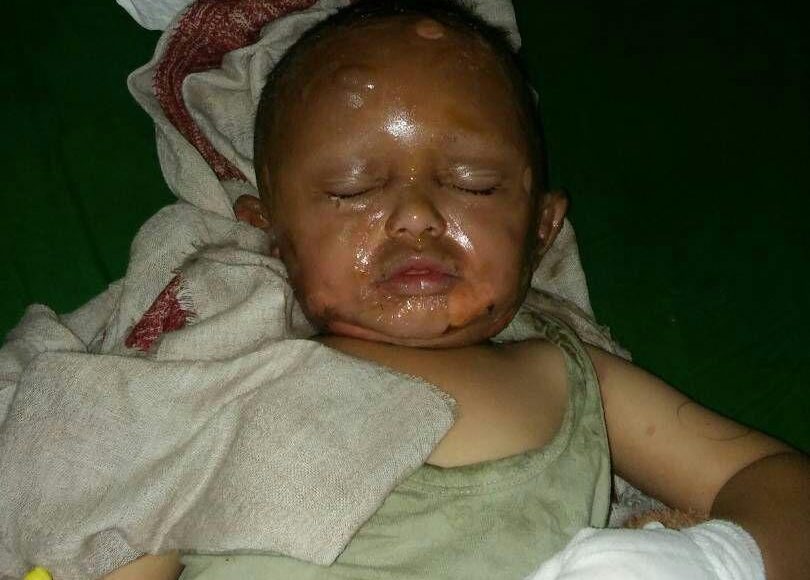 حرق بنت بانفجار اسطوانة غاز