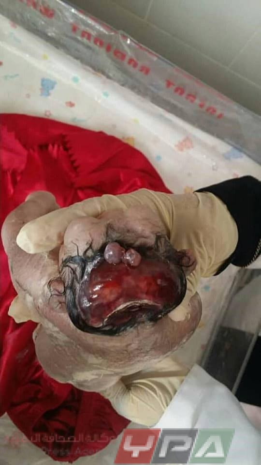 صورة المولود المشوّه أمس في المستشفى الجمهوري بصعدة 10 يناير 2019م